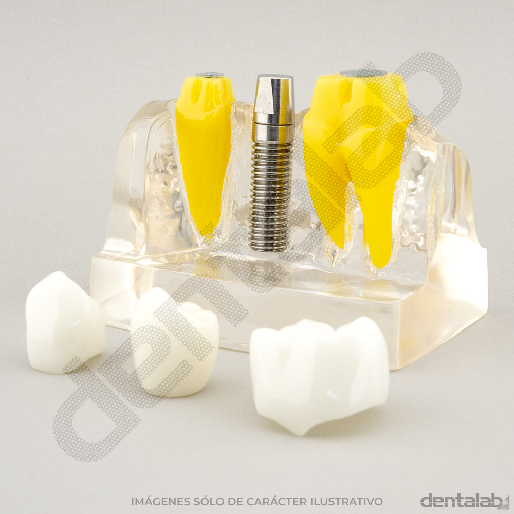 Macromodelo Acrílico Fijo 3 piezas (con Implante)