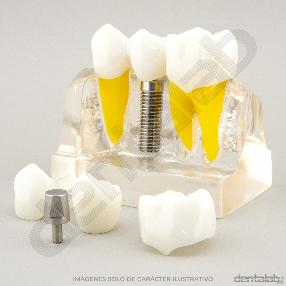 Macromodelo Acrílico Fijo 3 piezas (con Implante)