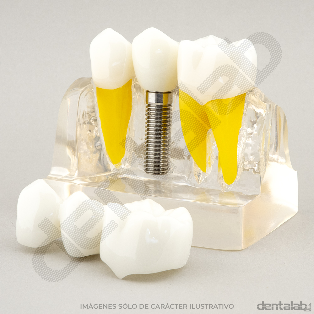 Macromodelo Acrílico Fijo 3 piezas (con Implante)