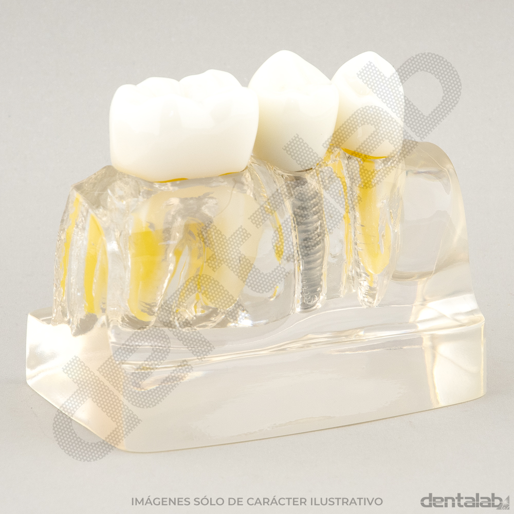 Macromodelo Acrílico Fijo 3 piezas (con Implante)